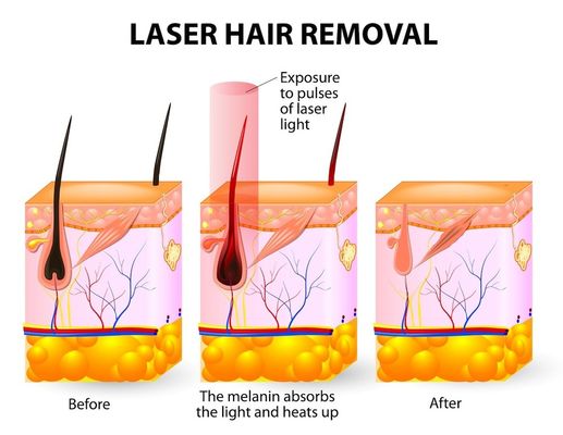 Máquina del retiro del pelo del laser del diodo del salón 20HZ 808 del balneario