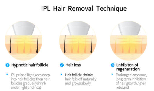 2000w tecnología láser del DIODO del OPT IPL+ 808NM para el equipo del retiro del pelo